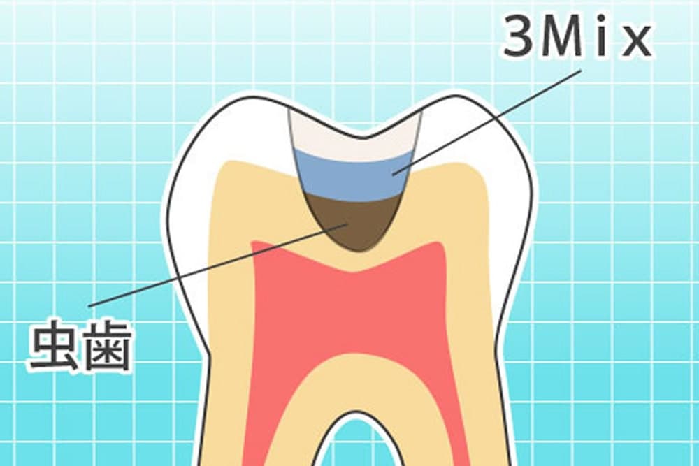 虫歯治療・根管治療