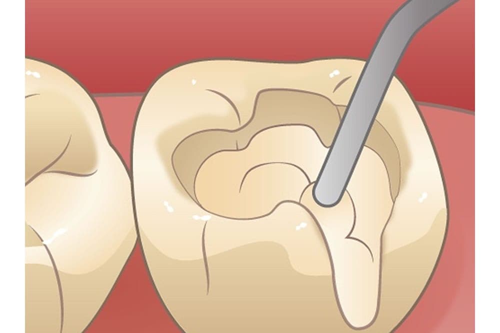 虫歯治療・根管治療