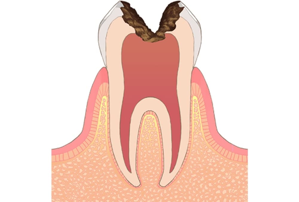 虫歯治療・根管治療