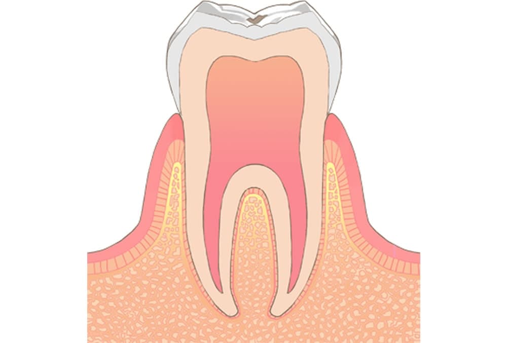 虫歯治療・根管治療