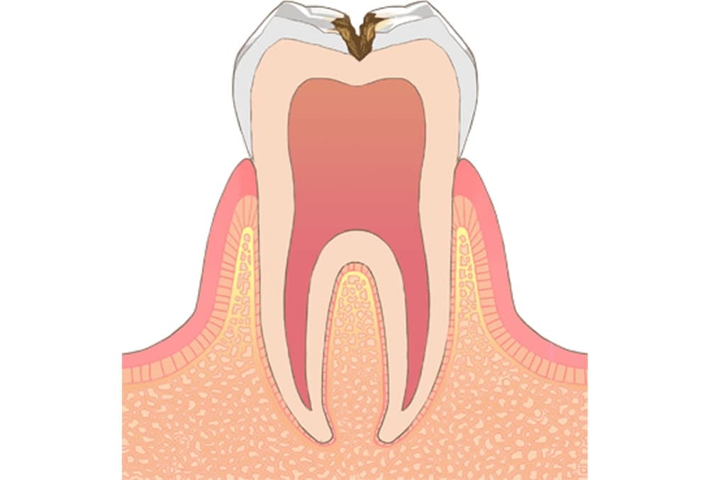 虫歯治療・根管治療