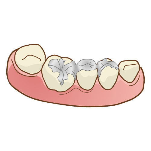 詰め物・被せ物（インレーやクラウン）の違いと共通点