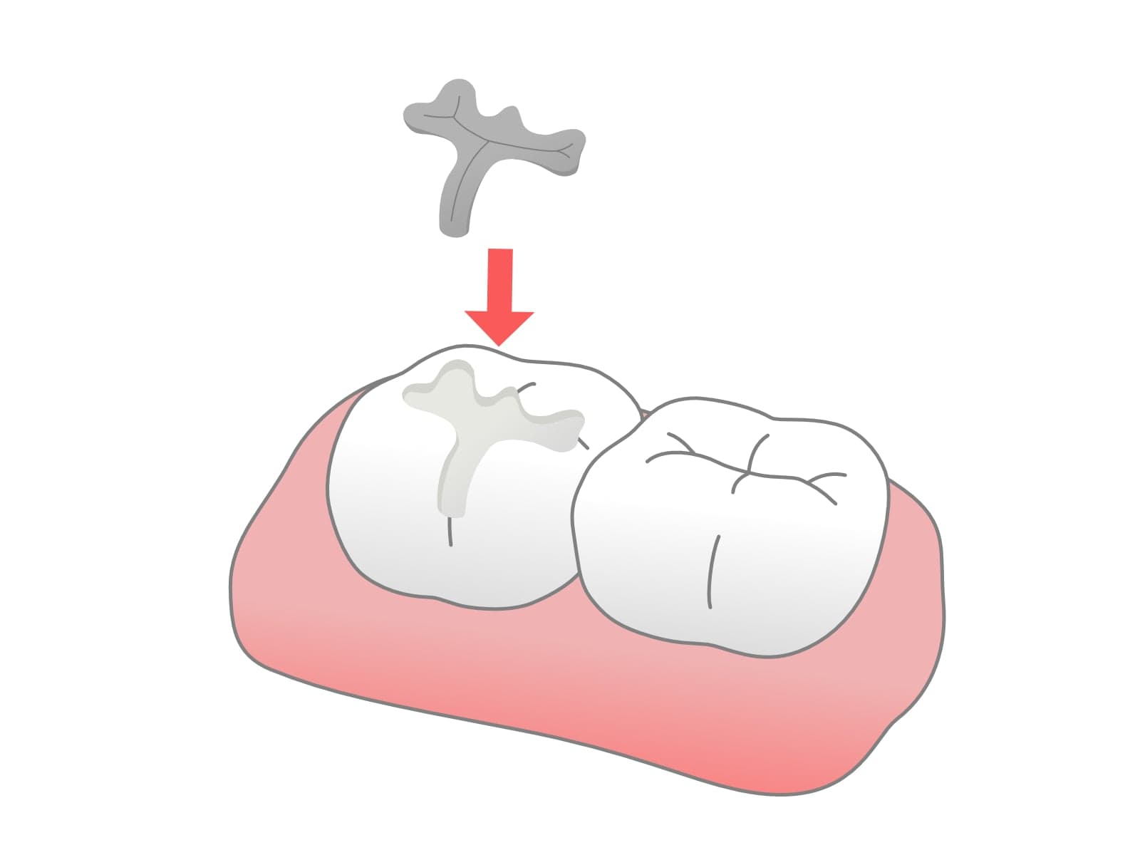 詰め物・被せ物（インレーやクラウン）の違いと共通点