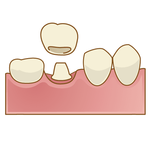 詰め物・被せ物（インレーやクラウン）の違いと共通点