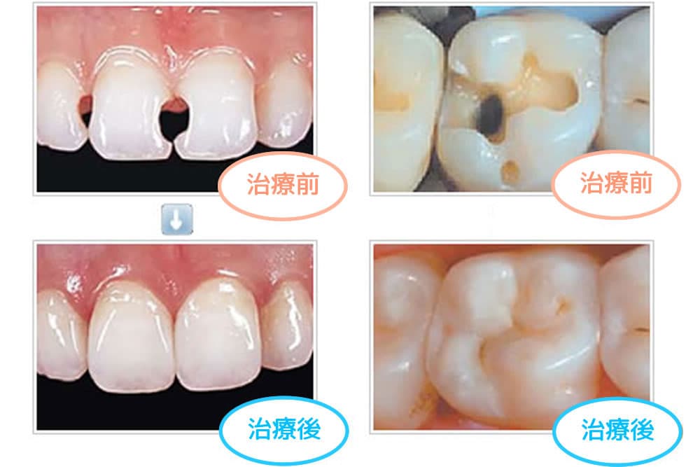 つめ物・かぶせ物(審美治療)