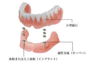 入れ歯・義歯