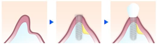 インプラント（口腔外科）