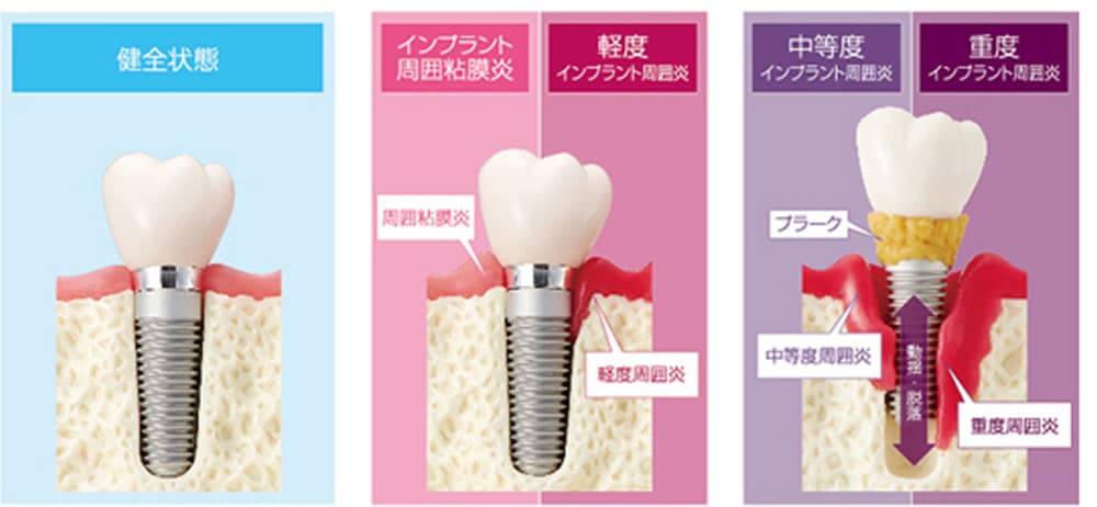 インプラント（口腔外科）