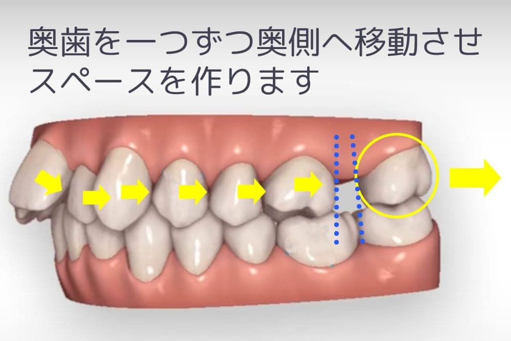 矯正歯科(裏側矯正・マウスピース矯正)