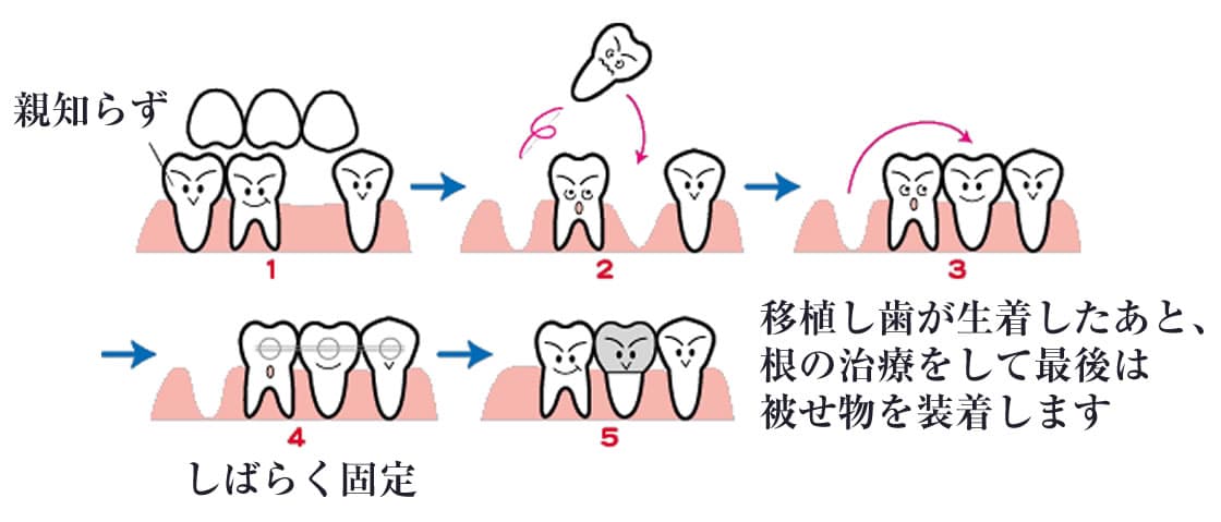 親知らずの抜歯・移植