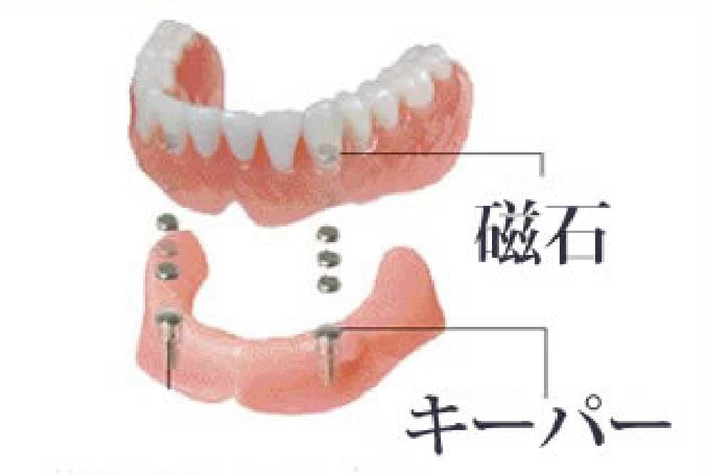 磁性アタッチメント義歯加工（入れ歯固定力向上オプション）