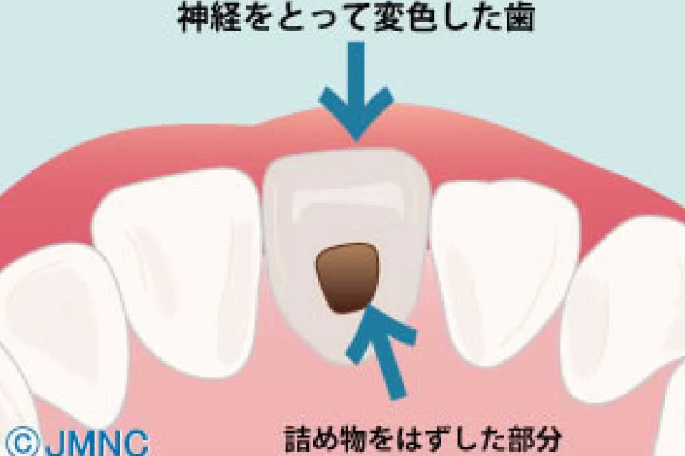 ウォーキングブリーチング 