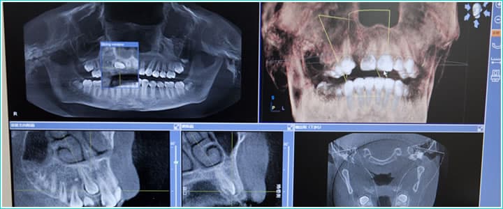 インプラント(口腔外科)
