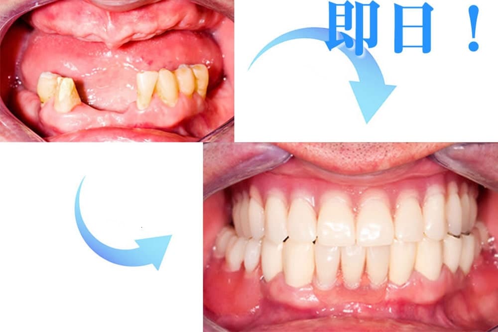 インプラント(口腔外科)