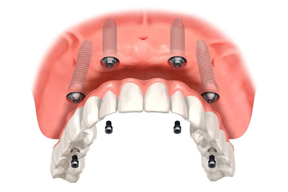 インプラント(口腔外科)