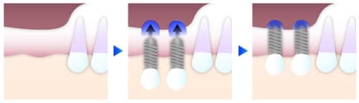 インプラント(口腔外科)