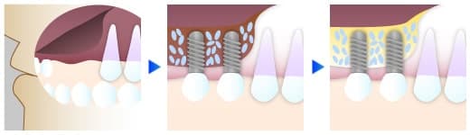 インプラント(口腔外科)
