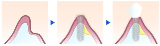 インプラント(口腔外科)