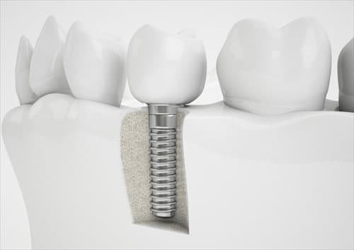 インプラント(口腔外科)