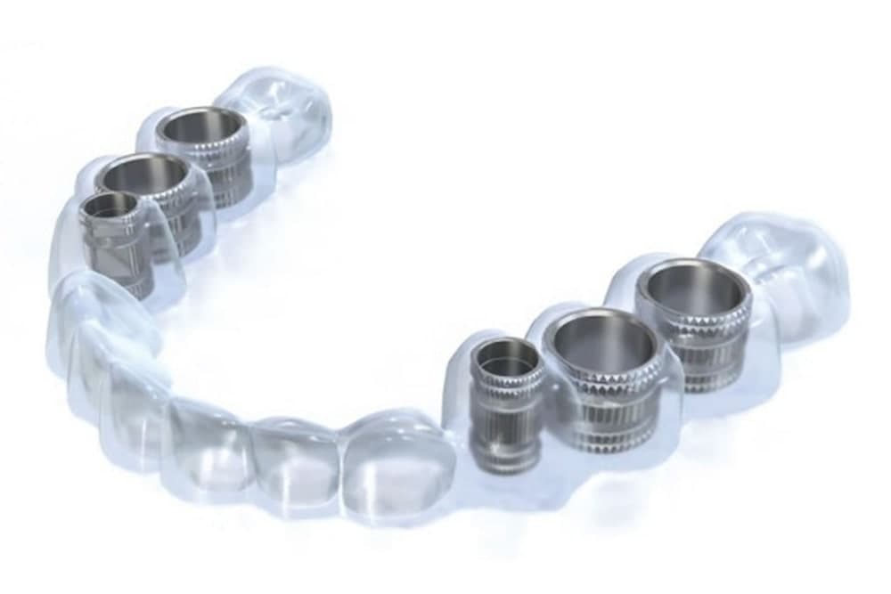 インプラント(口腔外科)