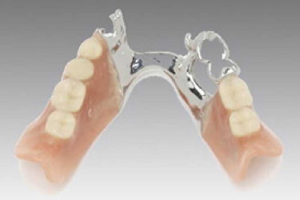 部分入れ歯 - 金属床(チタン)