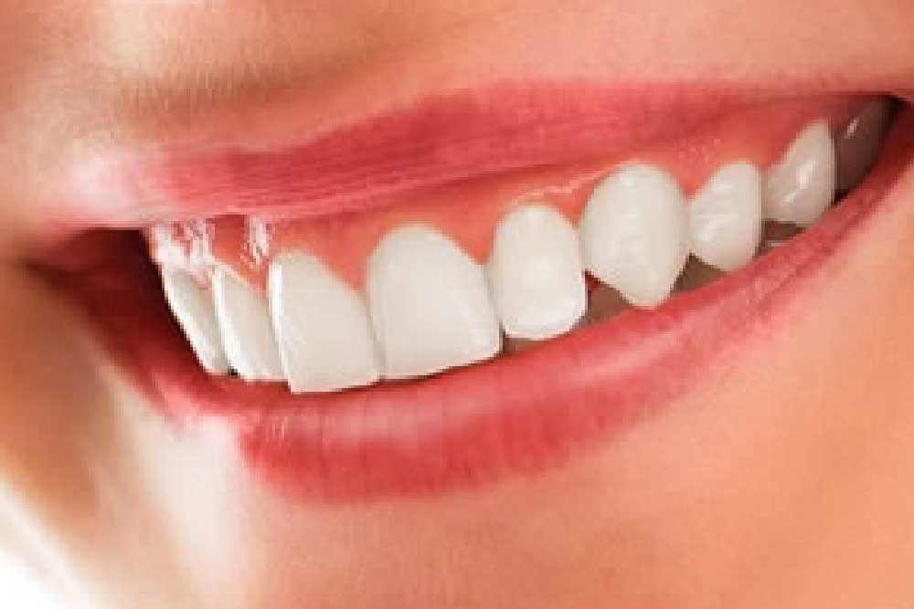 ガムブリーチ(ピーリング)